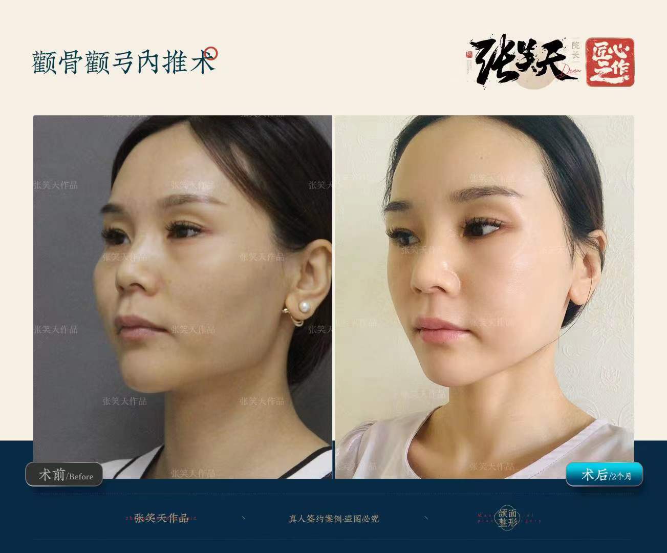 北京袁强博士拉皮面诊地址大揭秘:袁强博士拉皮手术费用