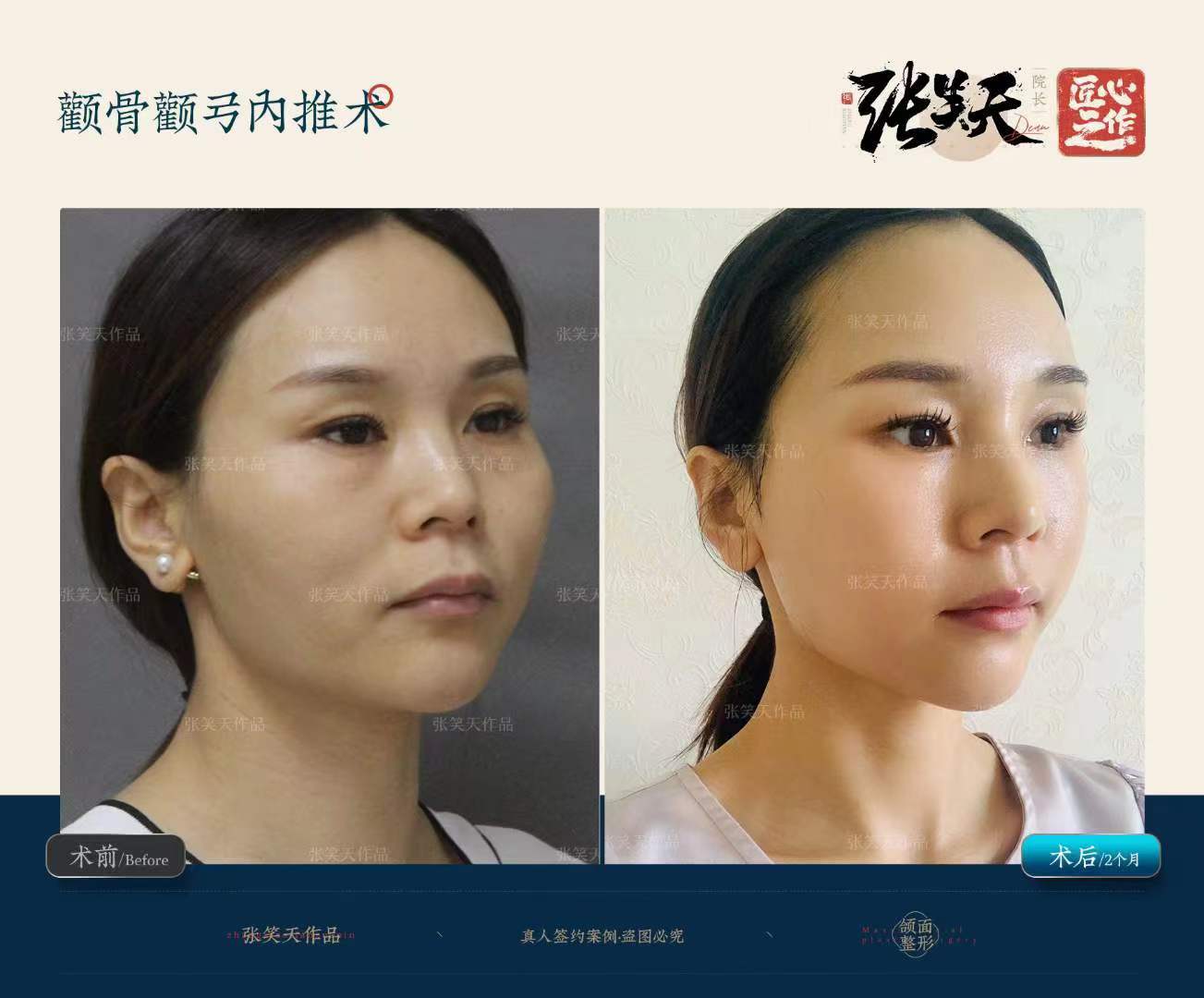 北京袁强博士拉皮面诊地址大揭秘:选择联合丽格第二医院的优势