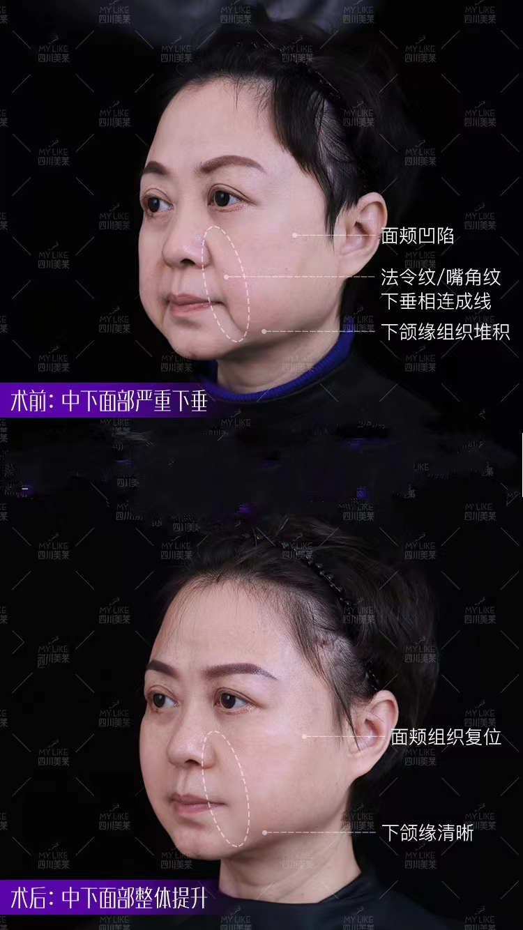 成都素美医院做无痕筋膜提升靠谱吗？
