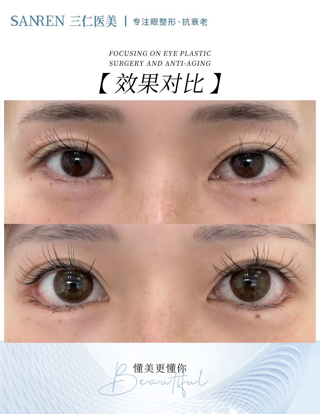 北京师丽丽眼修复厉害吗？揭秘其精湛眼修复技术 助您重获明亮动人双眸