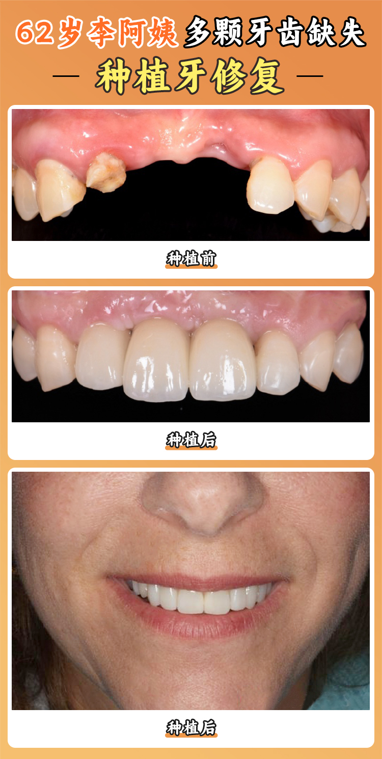 福州福能海峽口腔醫(yī)院是私人醫(yī)院嗎？正規(guī)靠譜種牙好，用實力打破民營刻板印象！ 