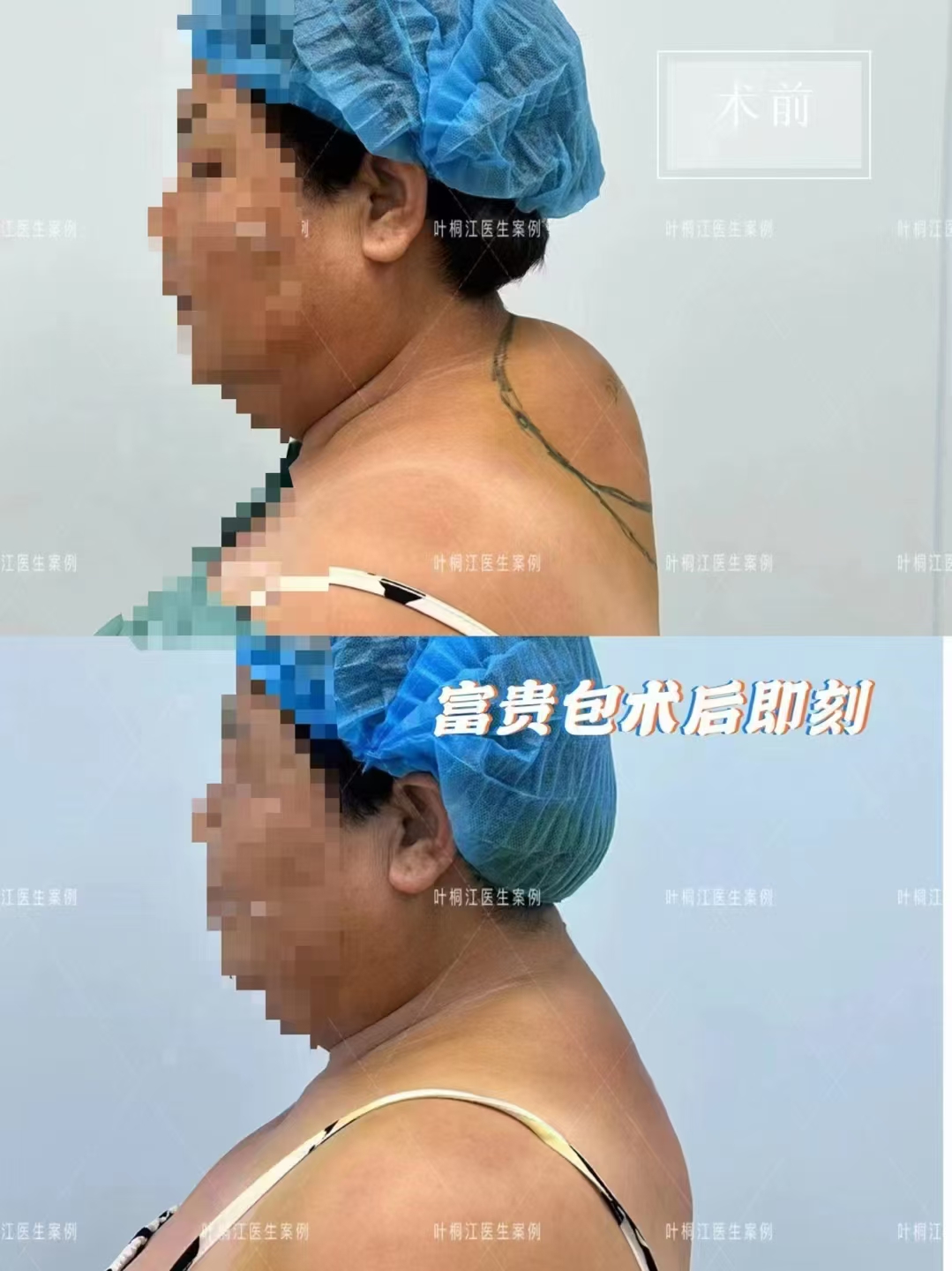 五、西安高一生杨占风医生技术与收费的综合评价