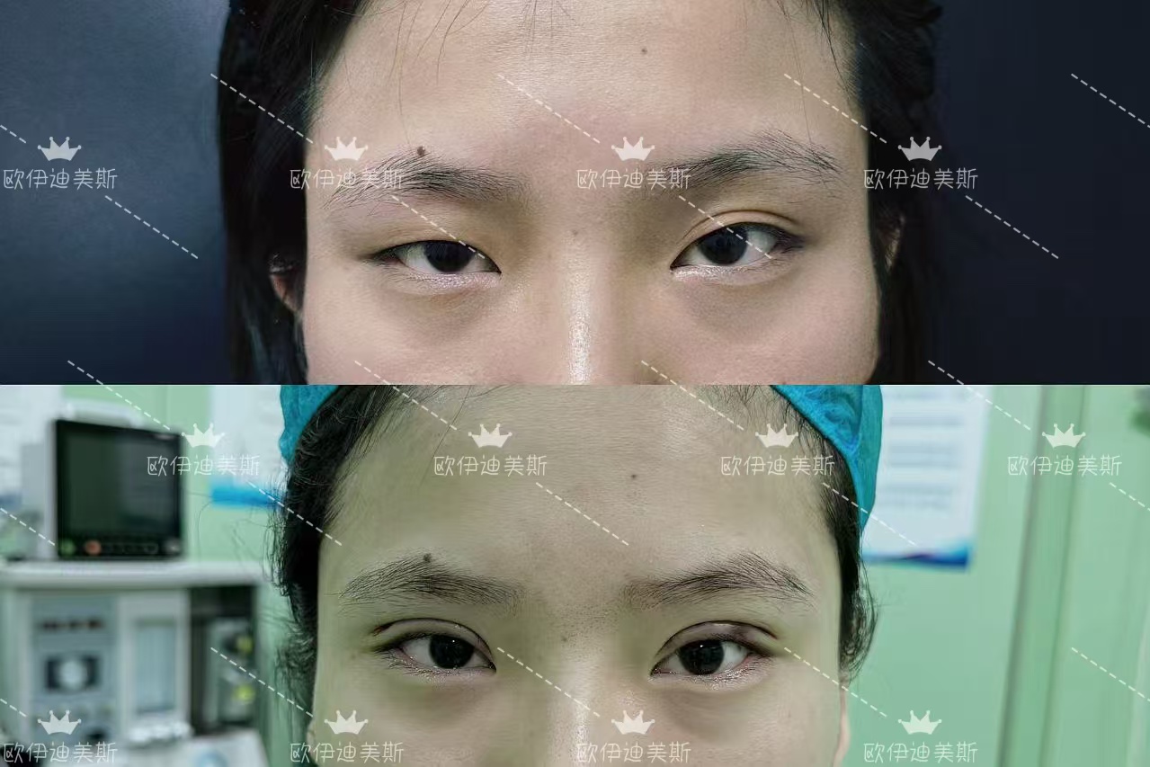 北京豐聯(lián)麗格師麗麗打造S - ACC青芒雙眼皮，僅12800元起開啟美眼之旅 