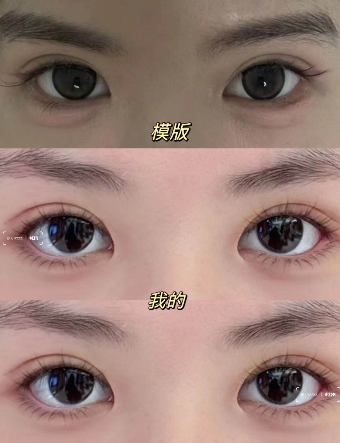 S - ACC青芒雙眼皮有哪些獨特優(yōu)勢？