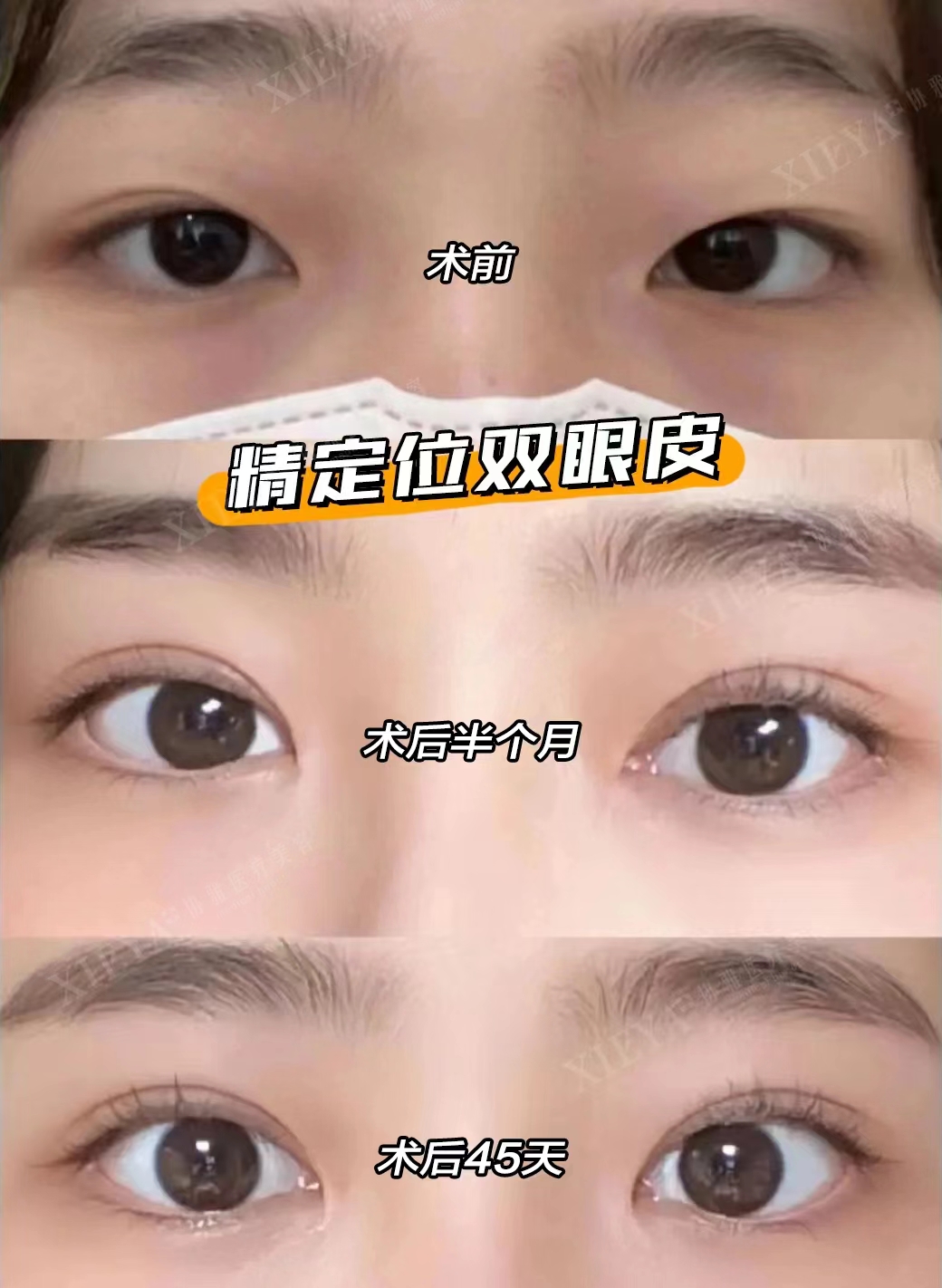 初眼手術(shù)價格受哪些因素影響？