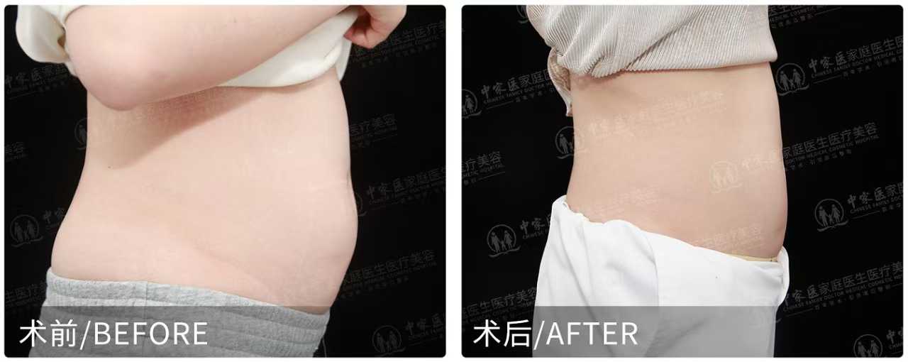 蔡跃波吸脂怎么样？5G天使光雕+分层保留术，腰腹环吸1.8万起，真实案例双下巴30天消失！