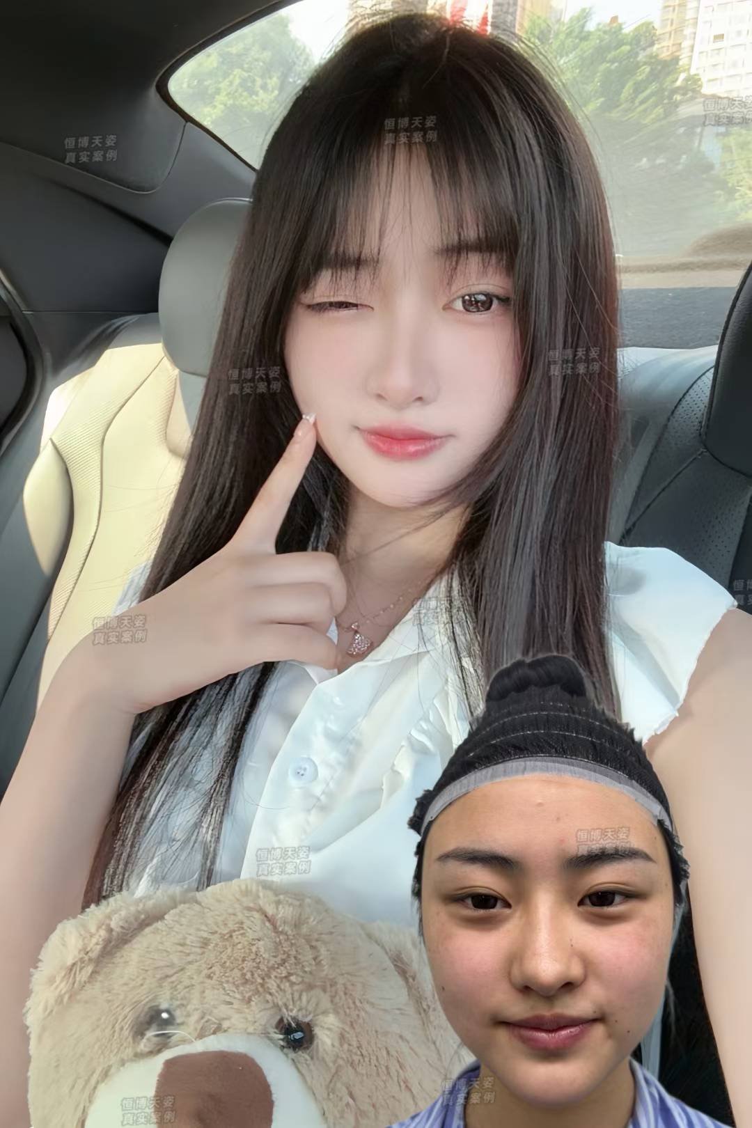 范榮杰醫(yī)生案例：從失敗鼻到能捏能揉的媽生鼻，這3項(xiàng)技術(shù)是關(guān)鍵