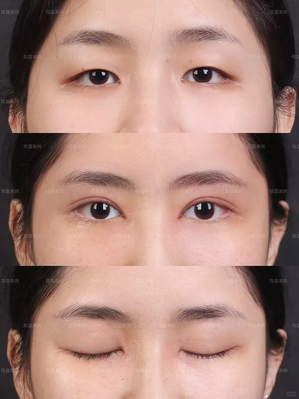 北京丰联丽格师丽丽亲诊！S-ACC切开双眼皮19800元起开启美眼之旅 