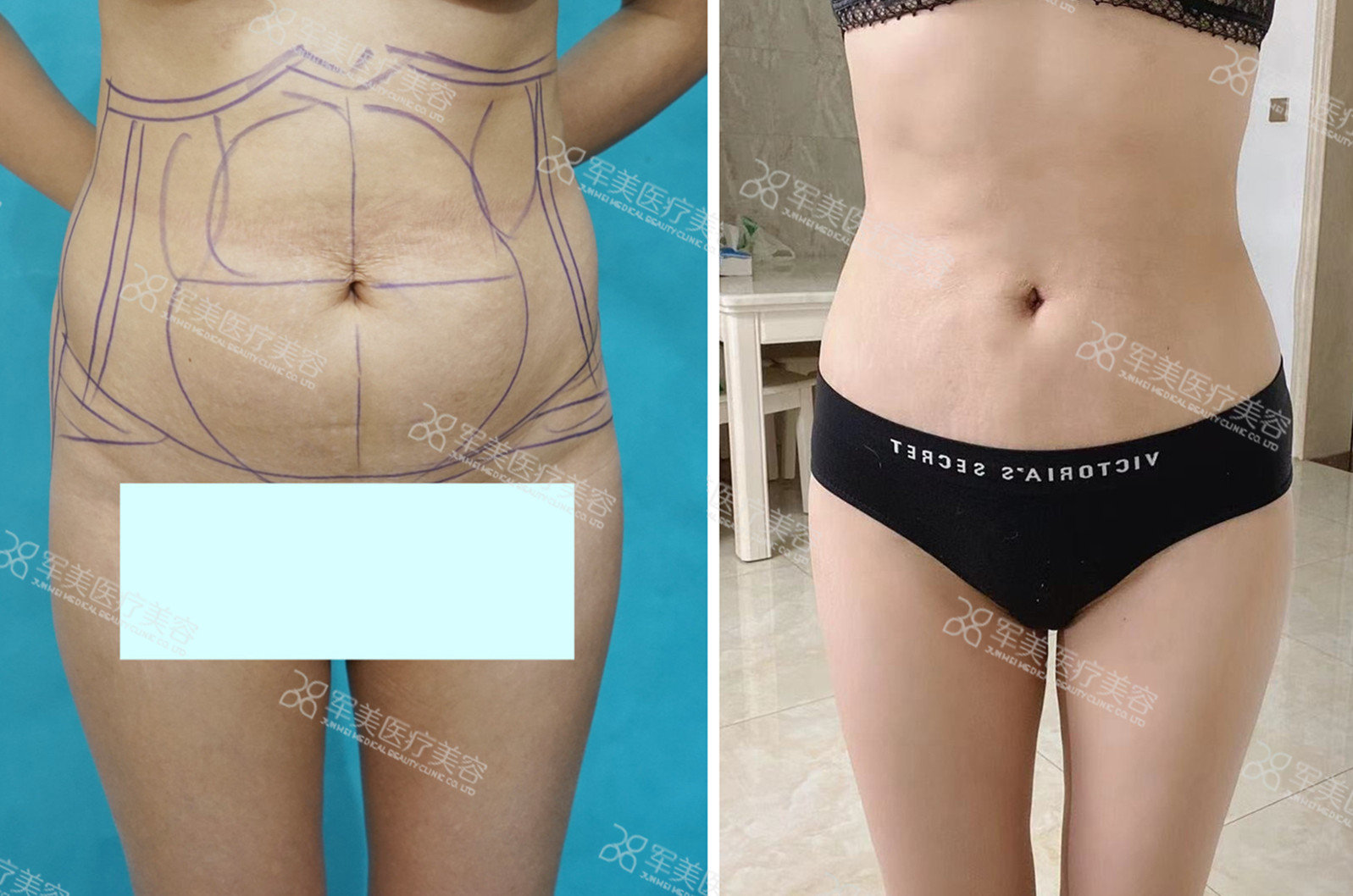 五、蔡跃波吸脂的就诊信息：医院正规，价格透明