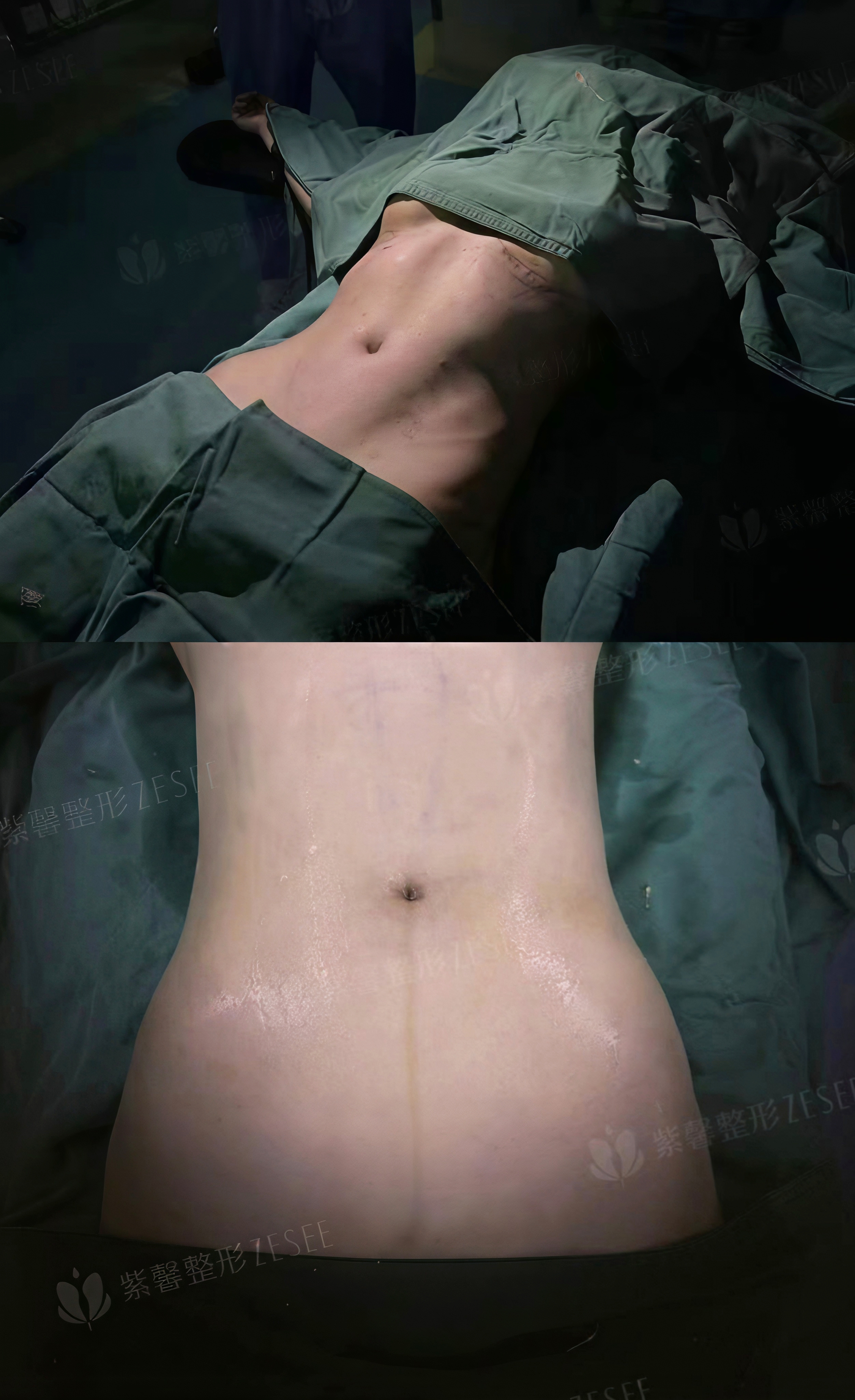 蔡跃波吸脂怎么样？总结：选对医生，就是选对成效