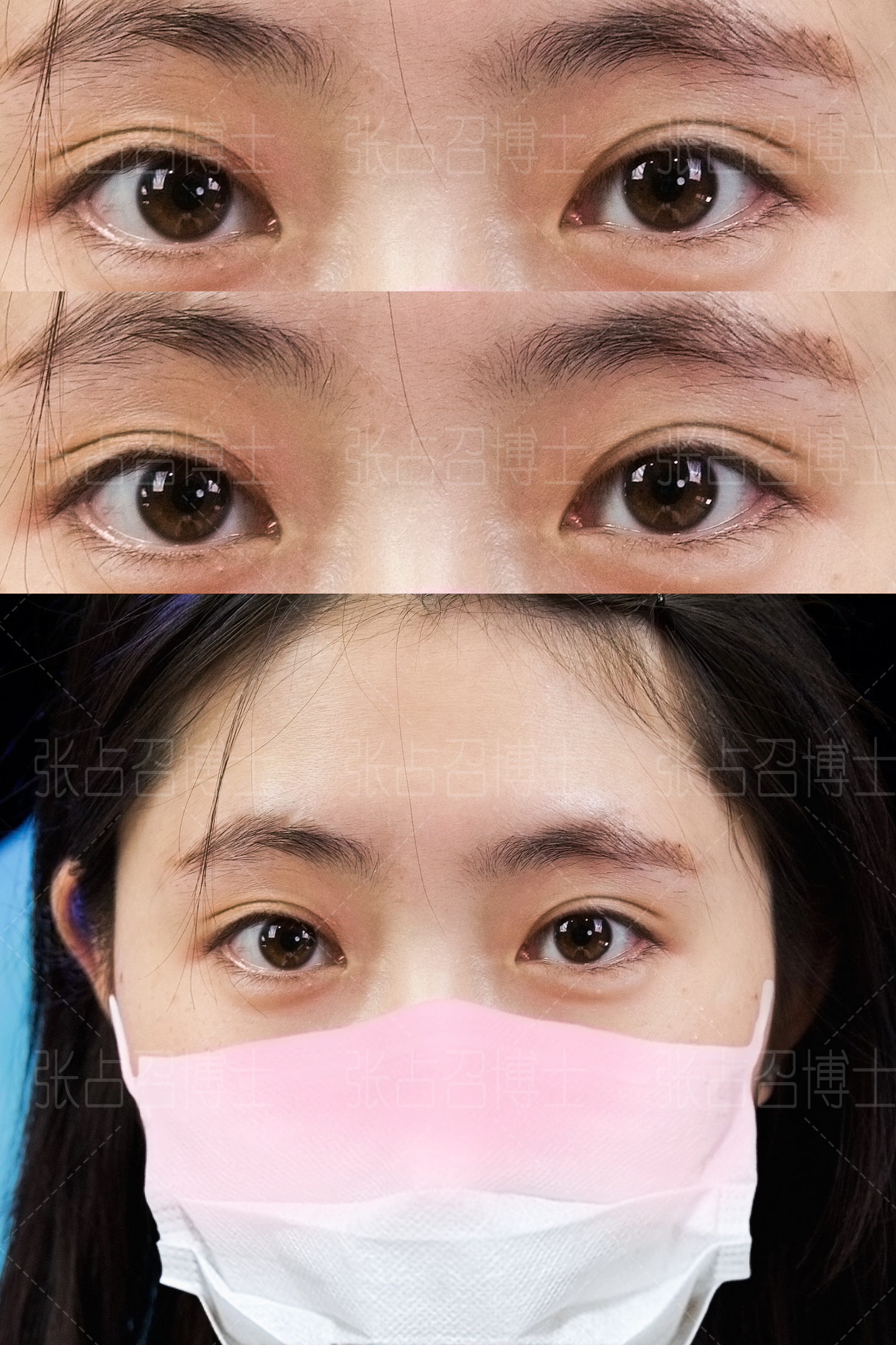 S - ACC切开双眼皮适合哪些人？