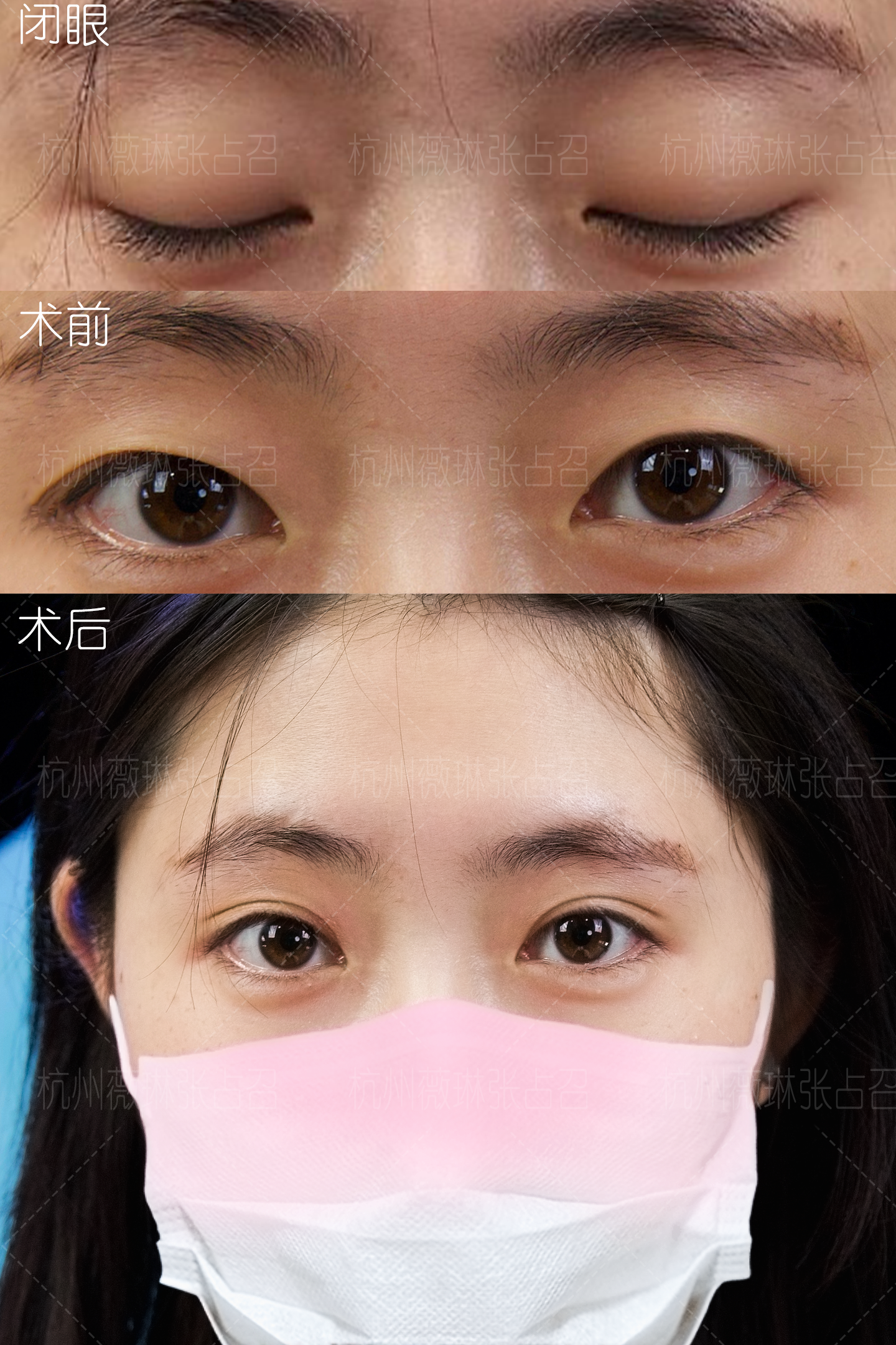 与其他眼部项目相比，S - ACC切开双眼皮有什么独特之处？