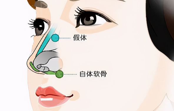 成都李丛丛隆鼻技术