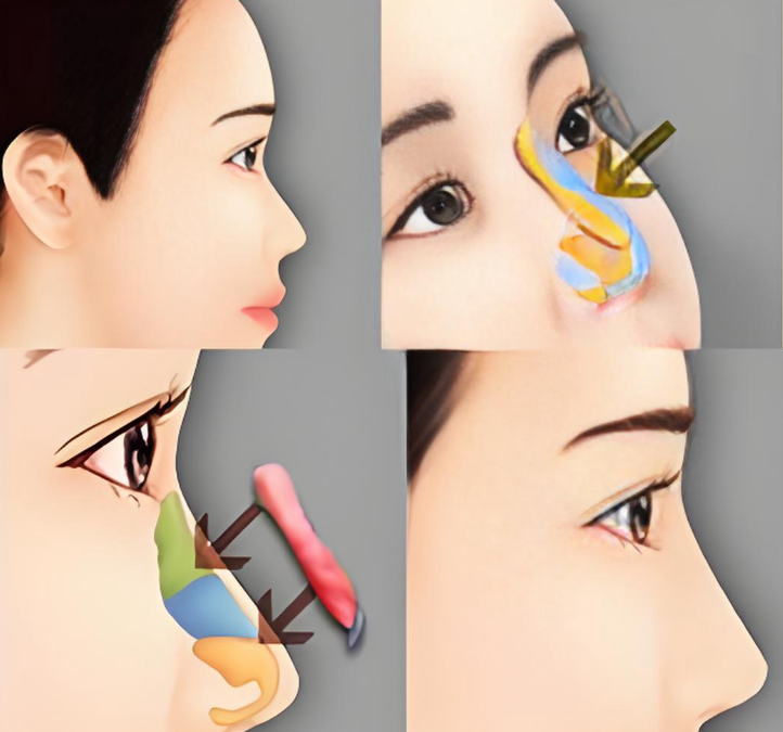 徐永丰鼻整形真实实例解析：20例反馈中的技术特点