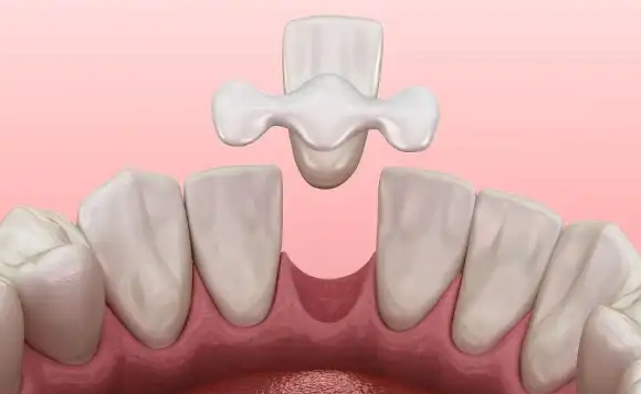 珠海補牙可以用統(tǒng)籌嗎？報銷規(guī)則+定點醫(yī)院價格+精準補牙技術全解析