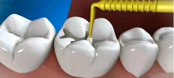 珠?？谇会t(yī)院：補牙價格與醫(yī)生推薦