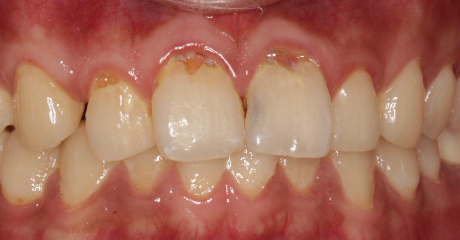 珠海補(bǔ)牙價(jià)格影響因素及應(yīng)對(duì)策略