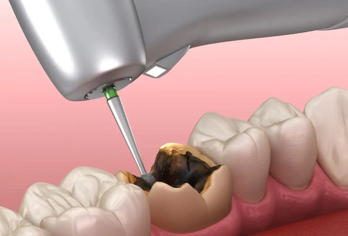 珠海補牙醫(yī)生：專精技術(shù)與患者口碑