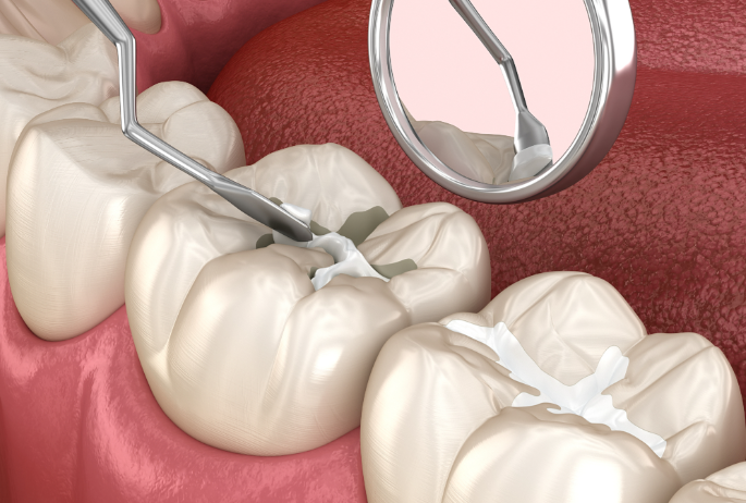 珠海斗門牙科醫(yī)院：補牙項目與推薦醫(yī)院