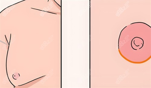 乳房缩小后术对比