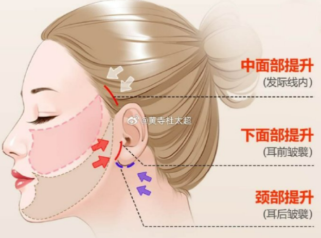 谢洋春拉皮手术排行第几名