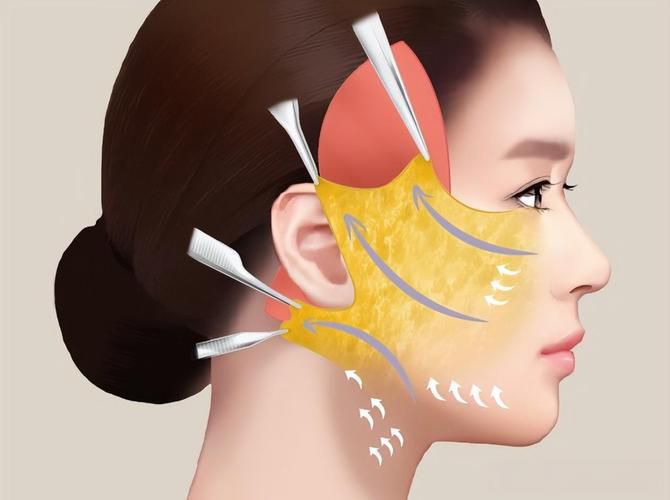 谢洋春拉皮手术费用价格表