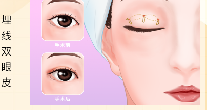 段艷軍雙眼皮修復(fù)的核心技術(shù)優(yōu)勢(shì)