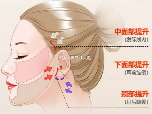 冯立哲拉皮手术价格表