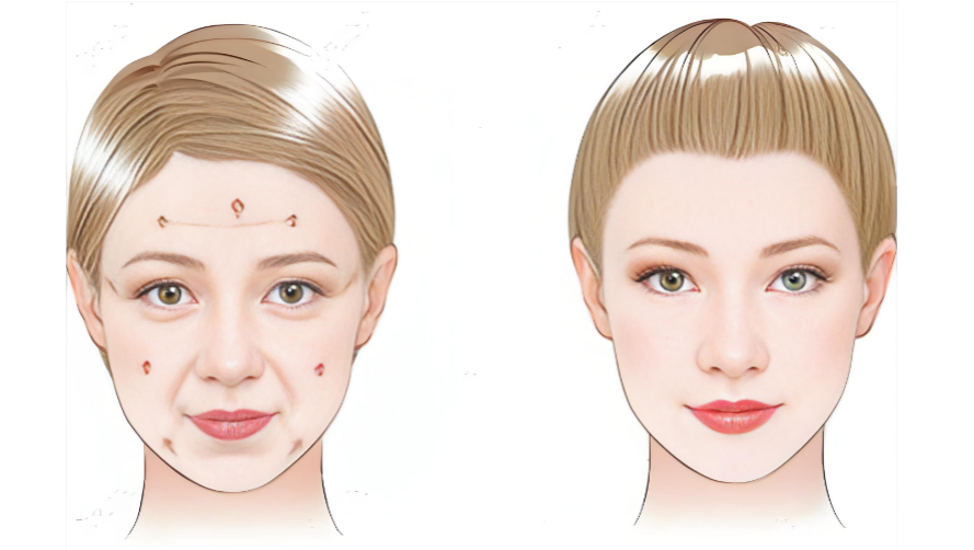 隋冰医生拉皮价格表