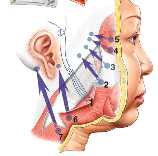 贵有贵的道理！北京刘暾博士苹果肌提升手术价格2.8-12万：超声骨刀剥离+风筝提拉
