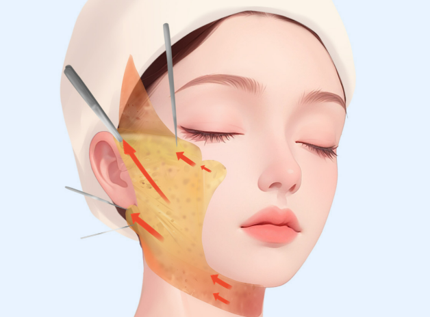 北京劉暾蘋果肌提升手術(shù)多少錢