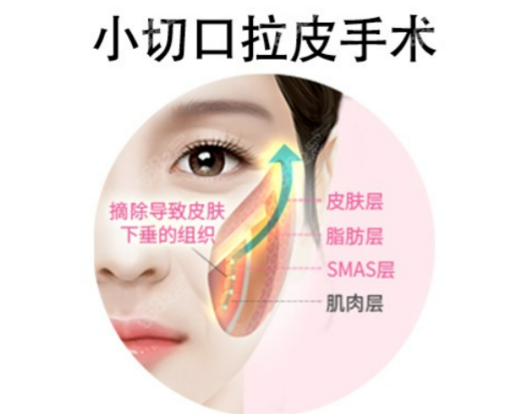 北京劉暾博士蘋果肌提升手術(shù)價(jià)格貴嗎