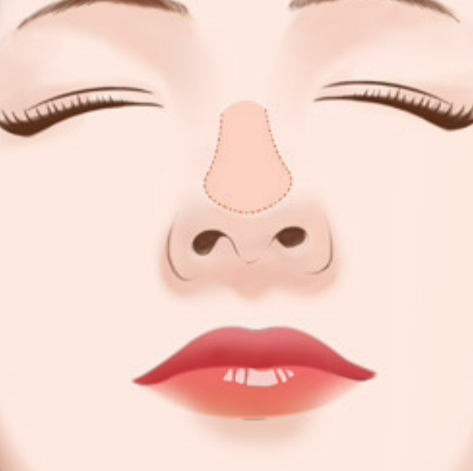 深圳張輝鼻整形在哪里