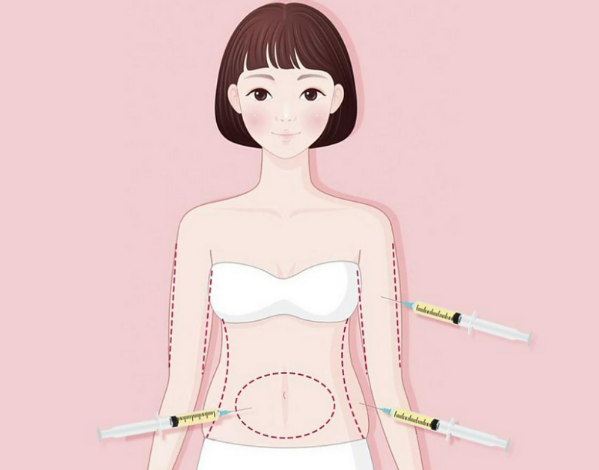 袁強(qiáng)醫(yī)生做腰腹部抽脂塑形怎么樣