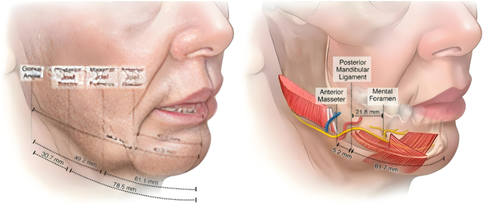 廣州陳兵拉皮手術(shù)原理
