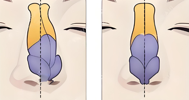 任天任天平歪鼻修復(fù)5-10萬起