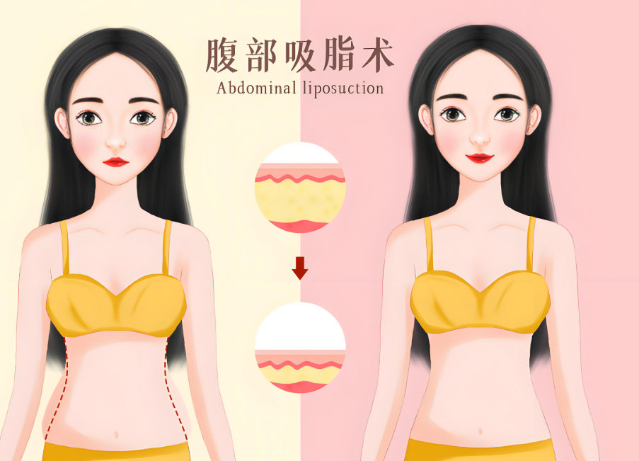 脂肪體雕黃奔醫(yī)生實測反饋