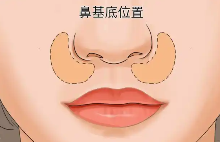 韓國(guó)鼻基底填充會(huì)移位嗎？一般不會(huì)，玻尿酸等不同方法風(fēng)險(xiǎn)評(píng)估