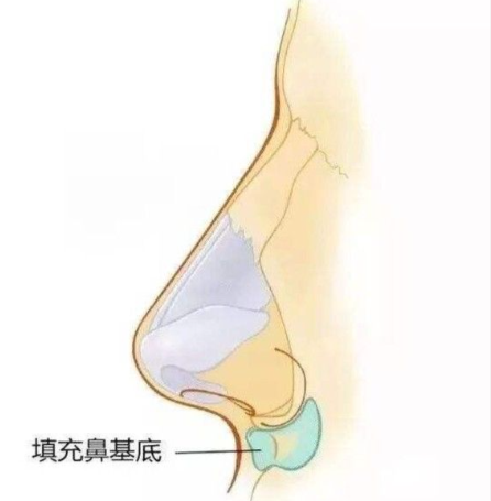 假體填充（硅膠、膨體等）