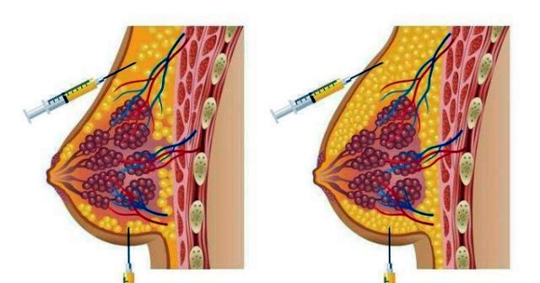 唐志榮隆胸怎么樣