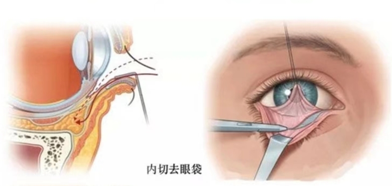 高富雷醫(yī)生祛眼袋預約方式