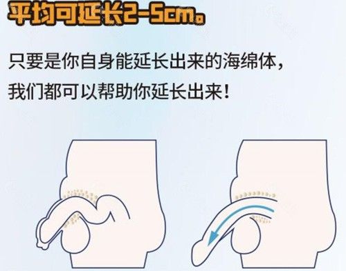 重慶劉彥龍延長增粗患者反饋