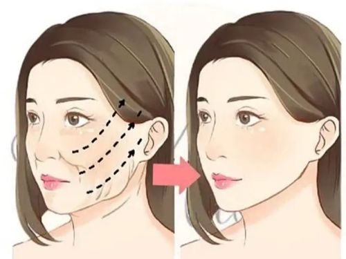 沈陽劉金超拉皮手術(shù)做的咋樣？小切口提拉5年不垮，真人術(shù)后對比圖實錘自然