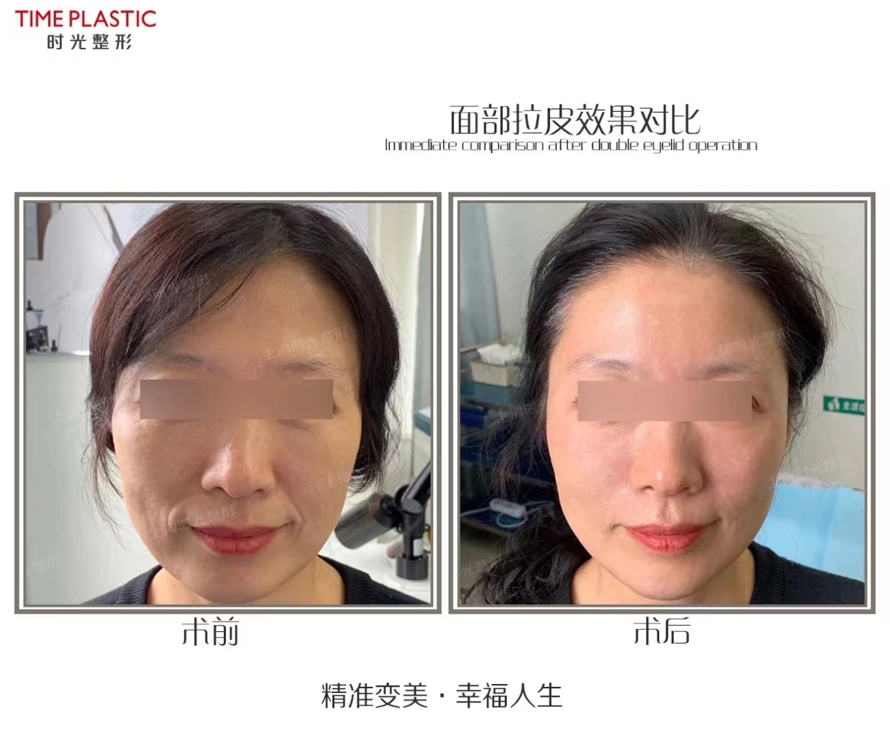 倪鋒醫(yī)生拉皮手術(shù)的個(gè)性化方案