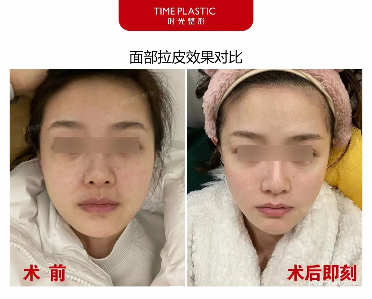 倪鋒醫(yī)生拉皮手術(shù)的真實(shí)實(shí)例