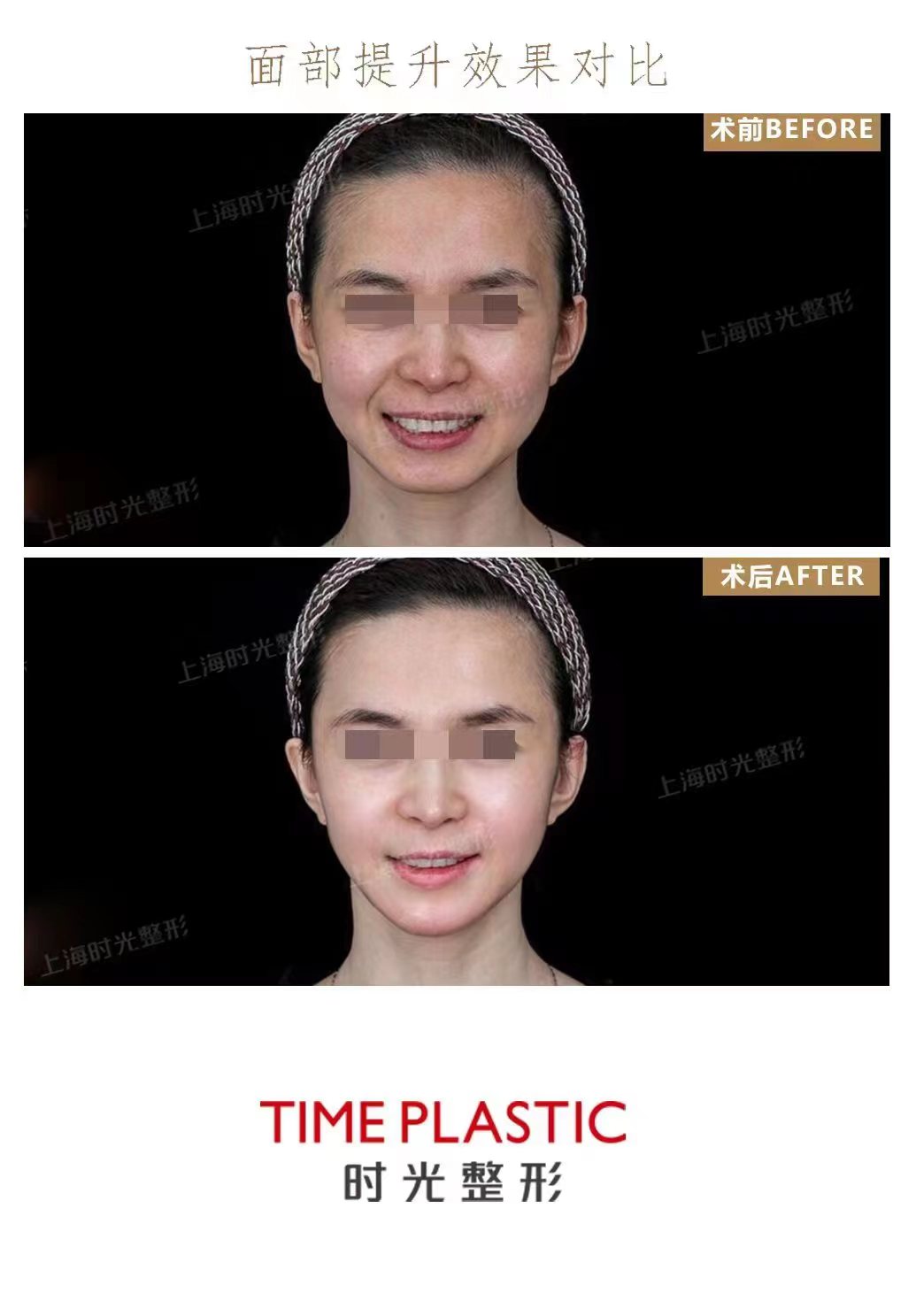 倪鋒醫(yī)生拉皮手術(shù)的價(jià)格與預(yù)約