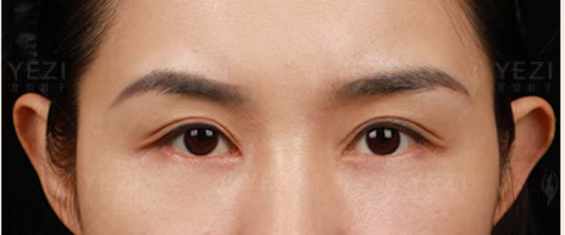 吳焱秋雙眼皮修復(fù)多少錢？揭秘知名醫(yī)生修復(fù)價(jià)格區(qū)間及高性價(jià)比修復(fù)方案 