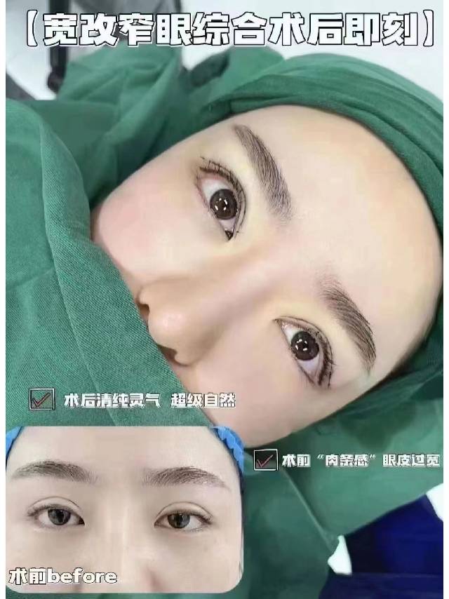 北京聯(lián)合麗格吳焱秋醫(yī)生修復雙眼皮，價格28800元起重塑眼部魅力！ 