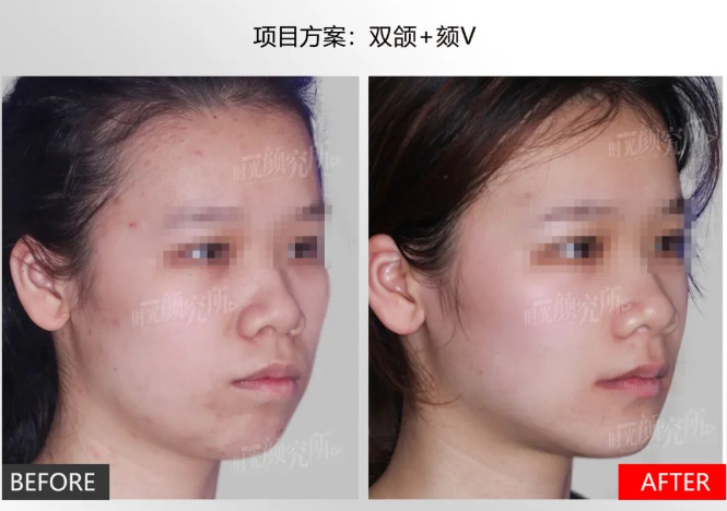 上海伊萊美醫(yī)療醫(yī)院：凹陷性疤痕修復骨干醫(yī)生