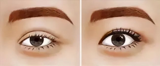 廣州雙眼皮張偉技術(shù)怎么樣